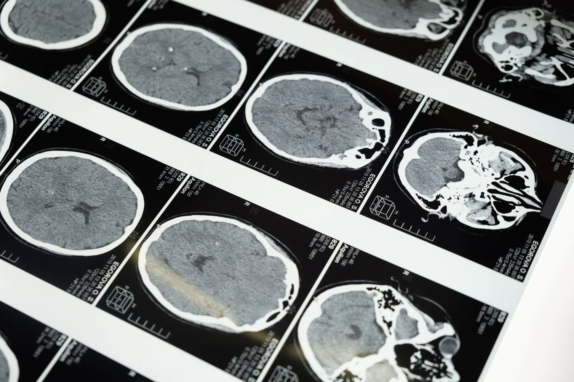 Sheets of brain scans laid out on a light table
